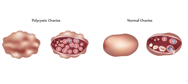 PCOS, infertility 